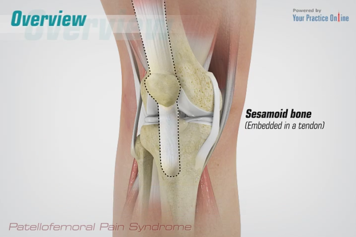 patellofemoral pain syndrome knee orthopaedics videos your patella femoral syndrome
