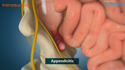 Appendicitis