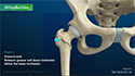 Subtrochanteric Hip Fracture