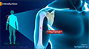 Rotator Cuff Bursitis