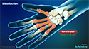 Metacarpal Fractures