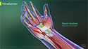 Open Carpal Tunnel Release Surgery