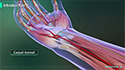 Mini-Open Carpal Tunnel Release Surgery