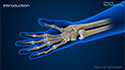 Total Wrist Arthrodesis