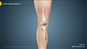 Revision Knee Replacement