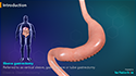 Sleeve Gastrectomy-Single Stage Procedure