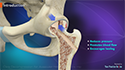 Core Decompression for Avascular Necrosis of the Hip