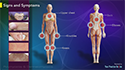 Polymyositis and Dermatomyositis