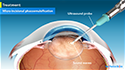 Micro-incisional phacoemulsification for Cataracts