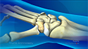 Thumb Arthroplasty