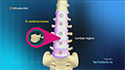 Posterior Lumbar Fusion