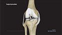 ACL Reconstruction with a Bone-Patellar Tendon-Bone (BPTB) Graft