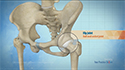 Ultrasound Guided Hip Injections