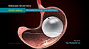 Gastric Balloon