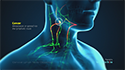 Cervical Lymph Node Dissection