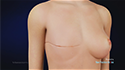Mastectomy: Simple, Skin Sparing and Nipple Sparing