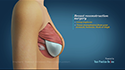 Implant Based Breast Reconstruction