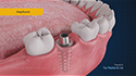 Dental Restorations