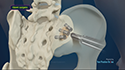 Sacroiliac Joint Fusion-Fixation-Stabilization