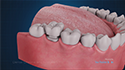 Dental Crowns and Bridges