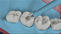 Composite Fillings