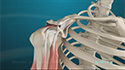 Shoulder Joint Replacement