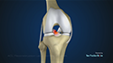ACL Reconstruction Using Achilles Allograft