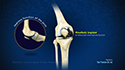 Robotic Unicondylar Knee Replacement