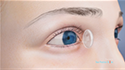 Corneal Transplantation