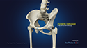 Partial Hip Replacement