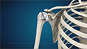 Simpliciti Canal-Sparing Total Shoulder Arthroplasty