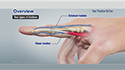 Flexor Tendon Injuries