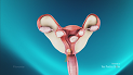 Fibroids