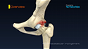 Femoroacetabular Impingement