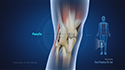 Fractures of the Patella