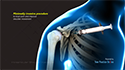 Intraarticular Shoulder Injections