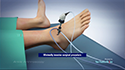 Ankle Arthroscopy