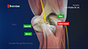 Cubital Tunnel Syndrome