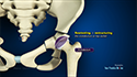 Pelvic Osteotomy