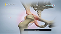 Hip Synovitis