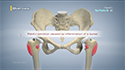 Hip Bursitis