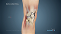 Minimally Invasive Knee Joint Replacement