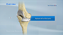 Total Knee Replacement