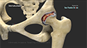 Minimally Invasive Total Hip Replacement