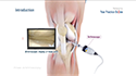 Knee Arthroscopy