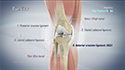 ACL Reconstruction Hamstring Method