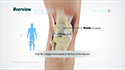 Patellofemoral Pain Syndrome