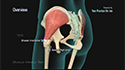 Gluteus Medius Tear