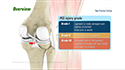 Posterior Cruciate Ligament Reconstruction