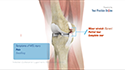 Medial Collateral Ligament Reconstruction